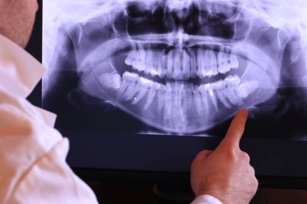 Best Emergency Tooth Extraction in Santa Barbara, CA
