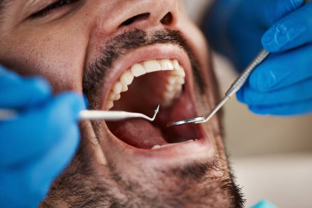 Best Emergency Wisdom Teeth Removal in Santa Barbara, CA