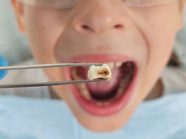 Best Emergency Treatment for Dental Infections or Abscesses in Santa Barbara, CA